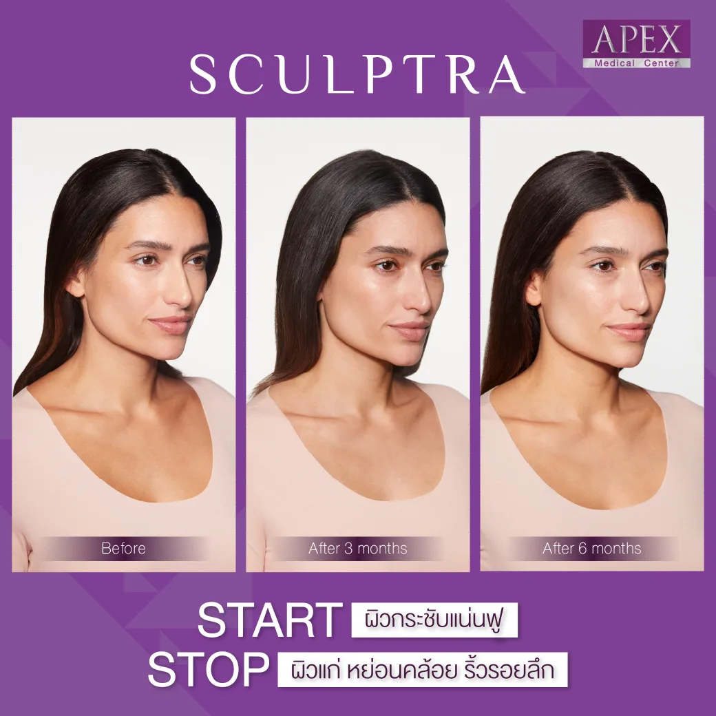 Apex ,apexmedicalcenter , เอเพ็กซ์ , เอเพ็กเมดิคอลเซ็นเตอร์ , เสริมความงาม , คลินิกเสริมความงาม, sculptra , sculptra ราคา , ฉีด sculptra , sculptra filler , Sculptra treatment , sculptra apex , sculptra คืออะไร , sculptra ที่ไหนดี , การทำ sculptra ดีอย่างไร, Sculptra clinic