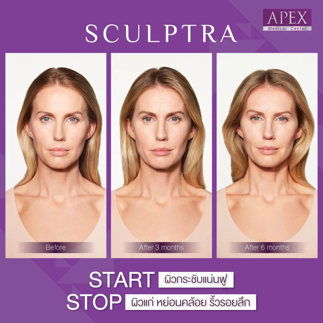 Apex ,apexmedicalcenter , เอเพ็กซ์ , เอเพ็กเมดิคอลเซ็นเตอร์ , เสริมความงาม , คลินิกเสริมความงาม, sculptra , sculptra ราคา , ฉีด sculptra , sculptra filler , Sculptra treatment , sculptra apex , sculptra คืออะไร , sculptra ที่ไหนดี , การทำ sculptra ดีอย่างไร, Sculptra clinic